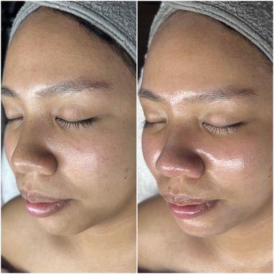 Hydrafacial Glow