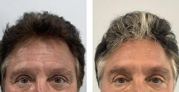 By using Botox to relax his muscles, we were able to reduce the fine lines and wrinkles in his forehead and around his eyes.