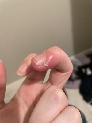 Pus draining from my infected cuticle.