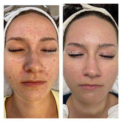 Acne before and after