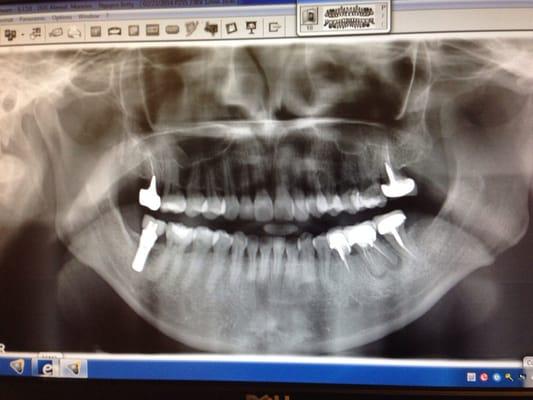 Look at the new technology of dental X-rays! Took less than 10 seconds! Boom!