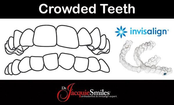 Crowded teeth, also known as malocclusion, is a condition that occurs when there is an insufficient amount of space in the mouth.