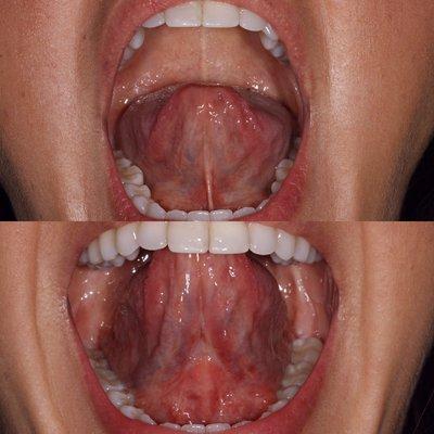 I help facilitate successful tongue tie releases (lingual frenectomy) with myofunctional therapy.