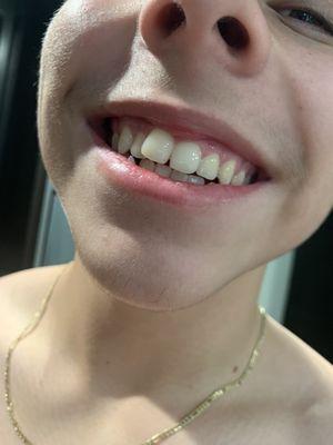 After: beautiful front teeth without spots