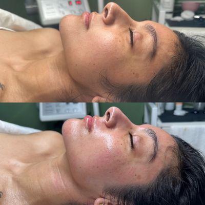 Dermaplane Facial Before & After