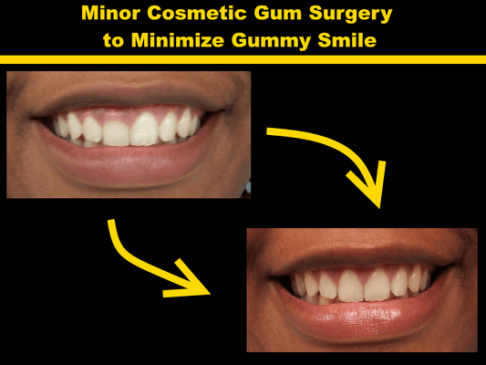 Minor Cosmetic Gum Surgery to Minimize Gummy Smile