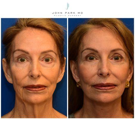 Face and Neck Lift, Upper and Lower Eyelid Blepharoplasty, Facial Fat Grafting, ZO Control Depth Peel