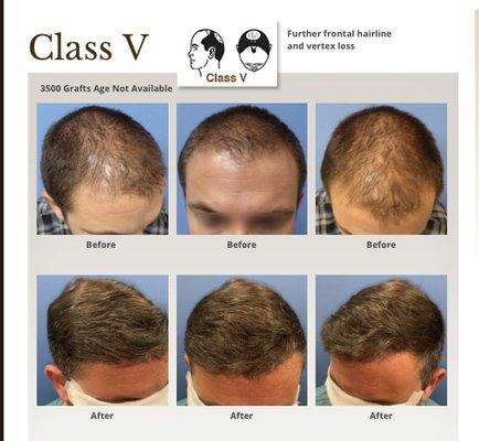 3000 grafts class 5