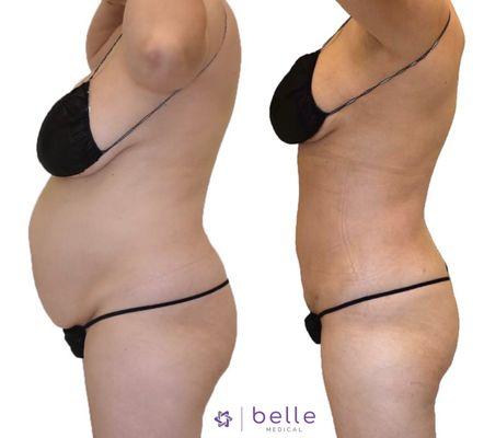 Before and After at Belle Medical