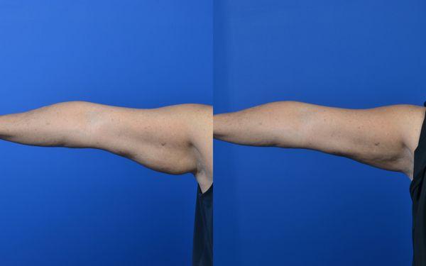 Smart Lipo to Arms