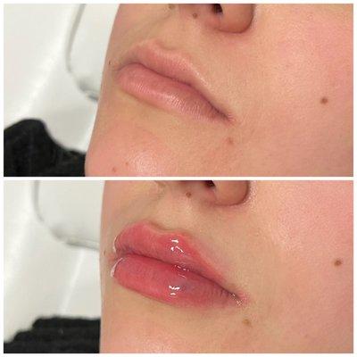 1mL lip enhancement