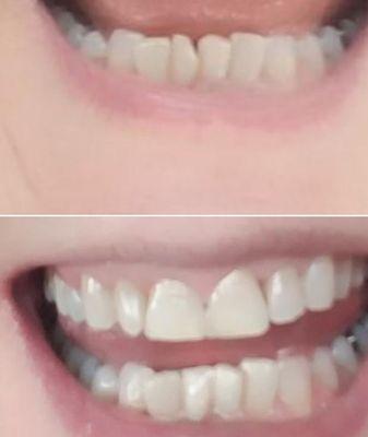 Cracked lower central incisor
 FIXED!