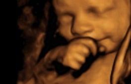 3D & 4D sonograms available