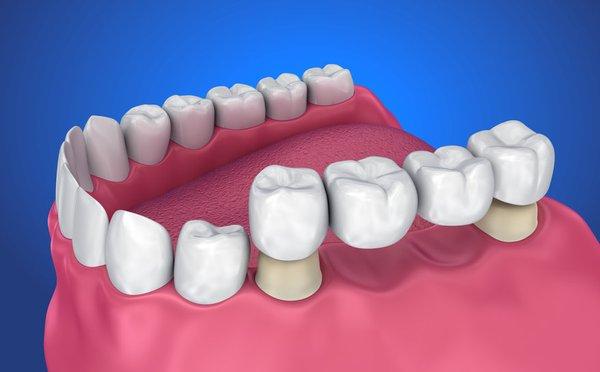 Dental Bridges North Las Vegas