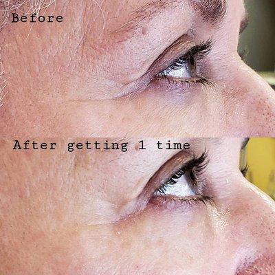 Skin meridian is really effective for removing wrinkles and fine line