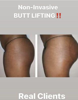 Non invasive Butt lifting treatment also we offer for the Breast