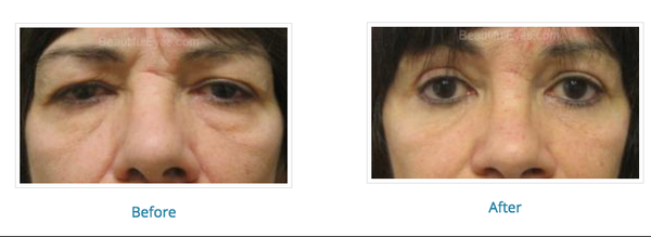 Endoscopic Brow - Edison, NJ