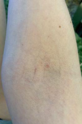 No bruises on my arm 10 hours after appointment :)