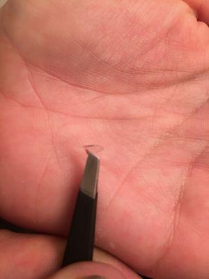 A piece of glass found in my boyfriends head they didnt get out before stiching him up, what a HUGE mistake