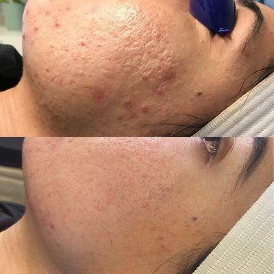 Acne and scar removal 3 sessions