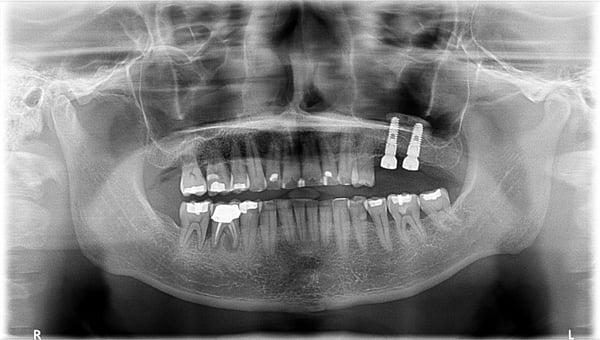 Implants and sinus lift bone graft done at the same time!