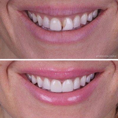 My veneers from Dr. Joelle