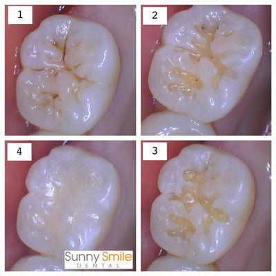 Biting surface cavity restored with natural white filling