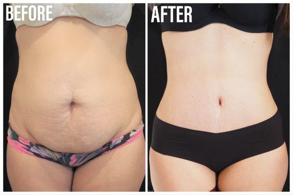 Tummy Tuck/Abdominoplasty