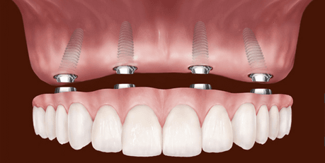 Denture supported by implants.