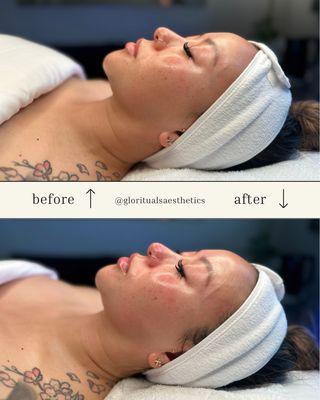 Glo Slow Hydrafacial + dermaplaning