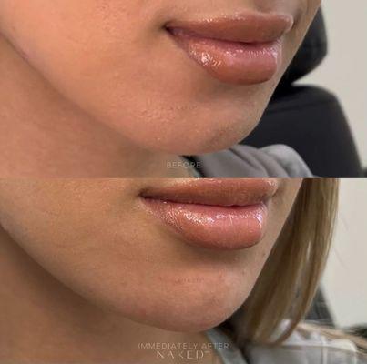 LIP FILLER BEFORE AND IMMEDIATELY AFTER