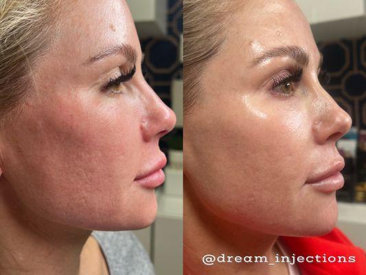 Skin booster injections, before and after 2 weeks. No makeup