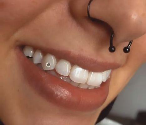 Teeth gems