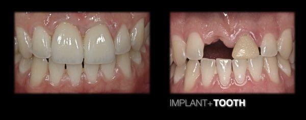 Reconstructing central incisors with precision