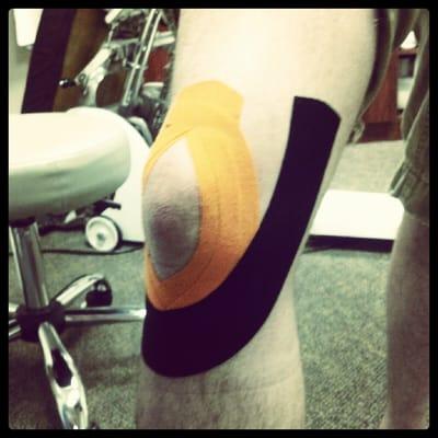 A kinesiology tape application for a MCL sprain that has been treated in our office.