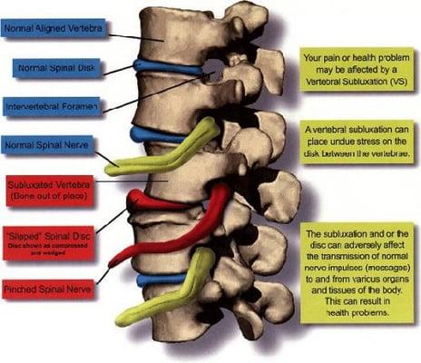 Pinched nerve also known as a subluxation