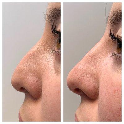 A non-surgical nose job by Nurse Lindsey!