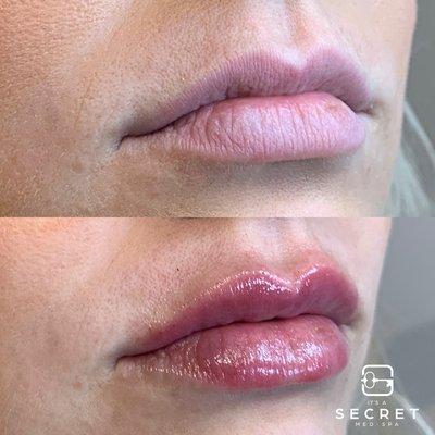 Natural Lip Filler