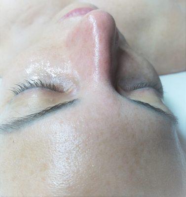 Non -Surgical Face-Lift