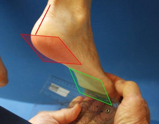 Green and red boxes representing the plane of the forefoot and plane of the heel. Learn more at evenkeelpodiatry.com