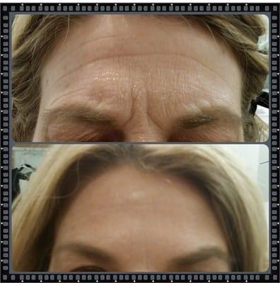 Frown lines injected with botox. A procedure that takes minutes but takes years off in the span of 4-7 days!