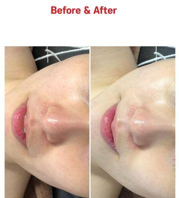 Microneedling Treatment:
 *Pores and Skin tightening 
 *Collagen production
 *Smooth fine lines 
 *Skin texture
 *Dark spots
 *Acne scars