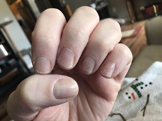 Damaged nail base after regular manicure.