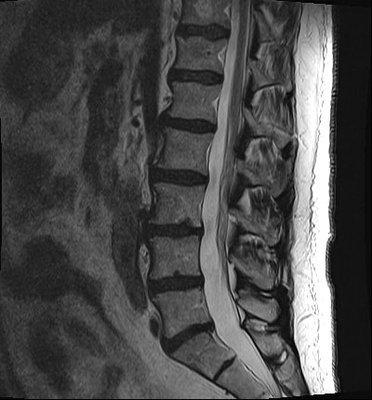 Example of L-Spine with Pathology