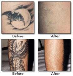 Tattoo REMOVAL