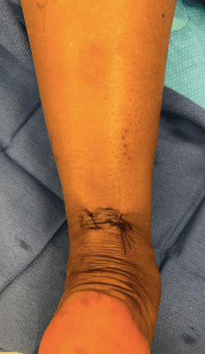 Minimally invasive achilles repair (PARS technique)