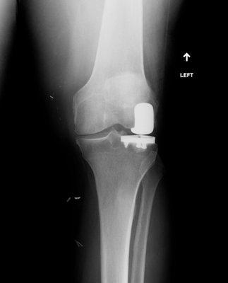 Lateral Partial Knee Replacement