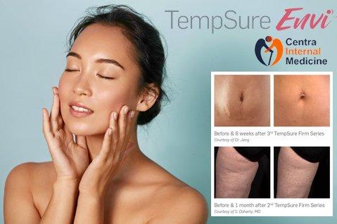 TempSure® Envi Skin Tightening for face and body