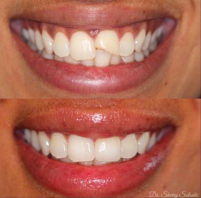 Patient fell and fractured her front tooth. Dr Sherry was able to restore her smile by only restoring one tooth with a porcelain crown