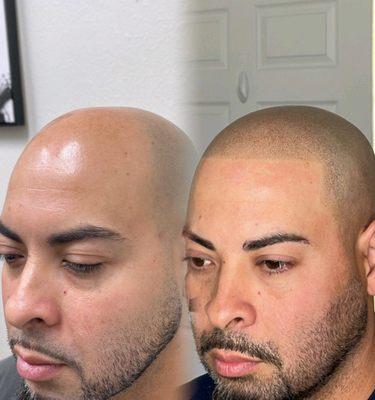 Roll back the years with Scalp Micropigmentation, SMP gives the natural look of a full head of hyper-realistic, freshly buzzed hair.